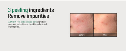 SOMEBYMI AHA-BHA-PHA 30 days Miracle Acne Clear Foam 100ml / 3.38 oz.